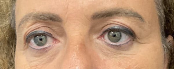 Blepharoplasty Before & After Gallery - Patient 308814 - Image 1