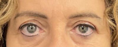 Blepharoplasty Before & After Gallery - Patient 308814 - Image 2