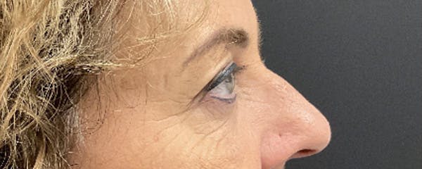 Blepharoplasty Before & After Gallery - Patient 308814 - Image 3