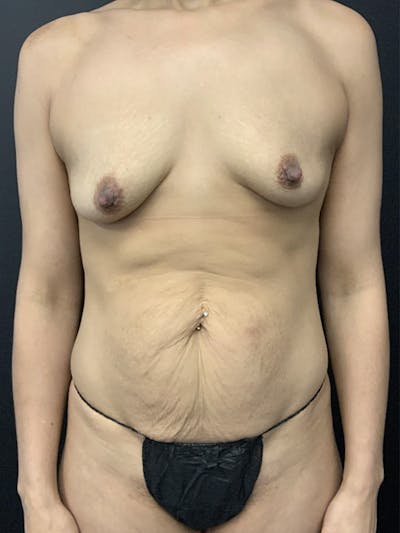 Mommy Makeover Before & After Gallery - Patient 136113 - Image 1