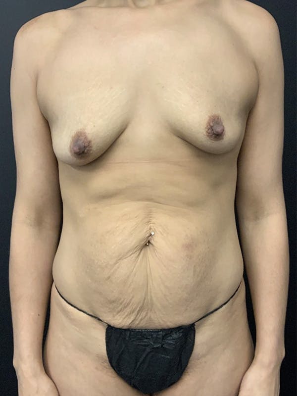 Mommy Makeover Before & After Gallery - Patient 136113 - Image 1