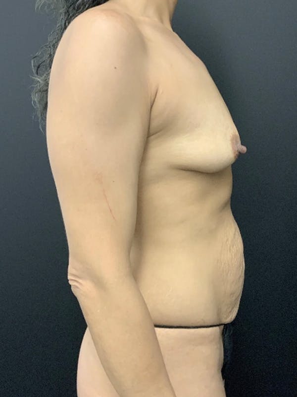 Mommy Makeover Before & After Gallery - Patient 136113 - Image 3