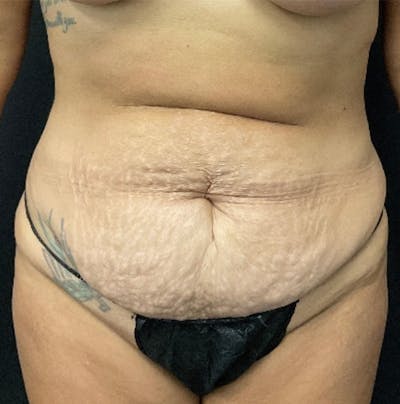Tummy Tuck Before & After Gallery - Patient 415217 - Image 1