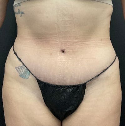 Tummy Tuck Before & After Gallery - Patient 415217 - Image 2