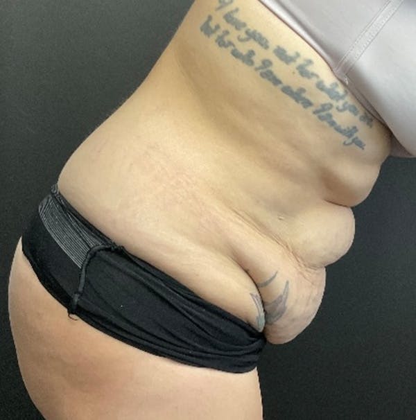Tummy Tuck Before & After Gallery - Patient 415217 - Image 5