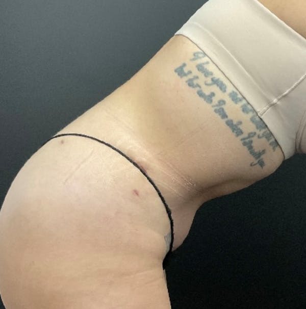 Tummy Tuck Before & After Gallery - Patient 415217 - Image 6