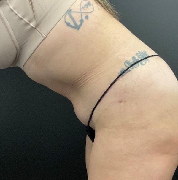 Tummy Tuck Before & After Gallery - Patient 415217 - Image 4