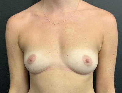 Breast Augmentation Before & After Gallery - Patient 103941 - Image 1