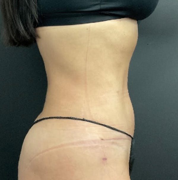 Tummy Tuck Before & After Gallery - Patient 324832 - Image 4
