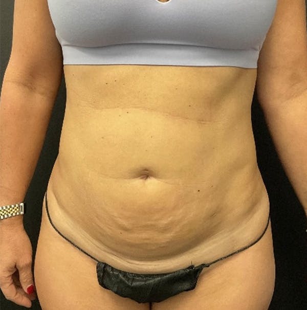 Tummy Tuck Before & After Gallery - Patient 324832 - Image 1