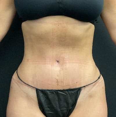 Tummy Tuck Before & After Gallery - Patient 324832 - Image 2