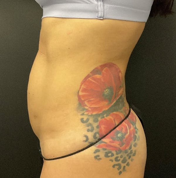 Tummy Tuck Before & After Gallery - Patient 324832 - Image 5