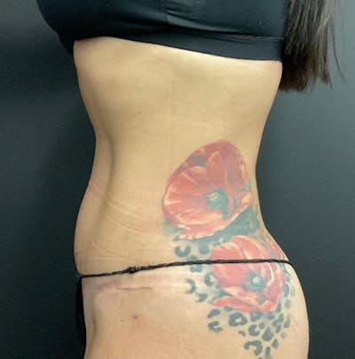 Tummy Tuck Before & After Gallery - Patient 324832 - Image 6