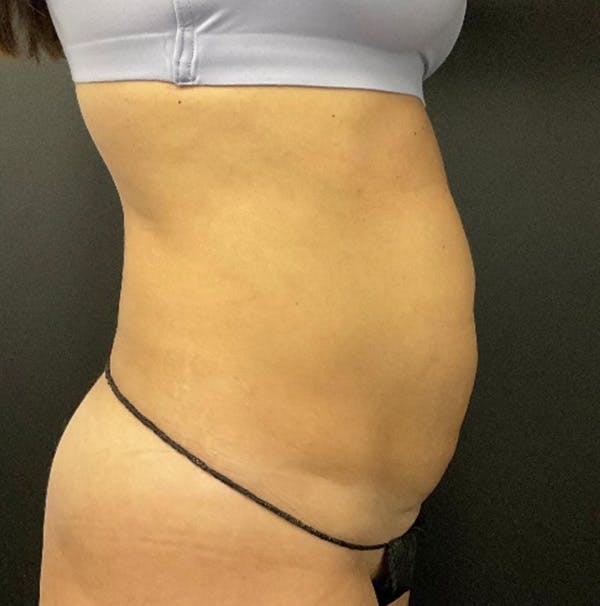 Tummy Tuck Before & After Gallery - Patient 324832 - Image 3