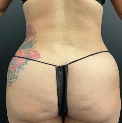 Tummy Tuck Before & After Gallery - Patient 324832 - Image 8