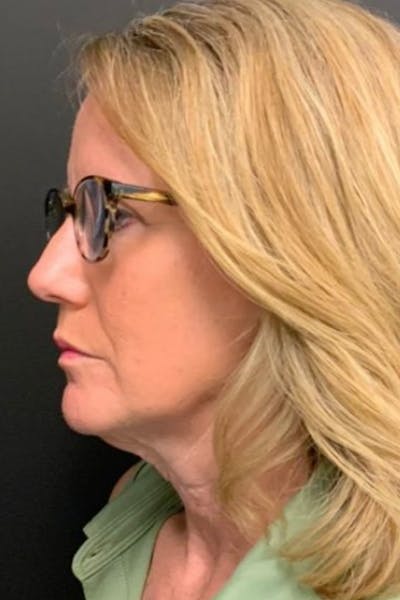 Neck Lift Before & After Gallery - Patient 827533 - Image 1