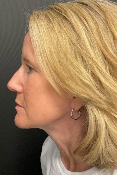 Neck Lift Before & After Gallery - Patient 827533 - Image 2