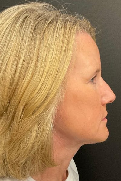Neck Lift Before & After Gallery - Patient 827533 - Image 4