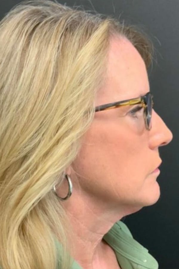 Neck Lift Before & After Gallery - Patient 827533 - Image 3
