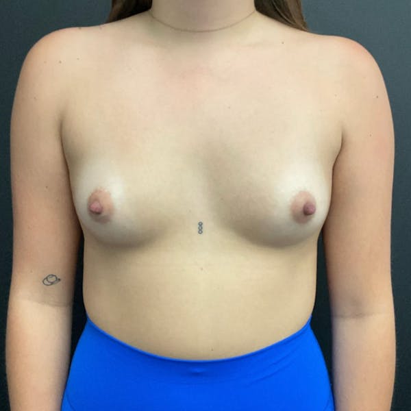 Breast Augmentation Before & After Gallery - Patient 315382 - Image 1