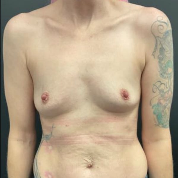 Breast Augmentation Before & After Gallery - Patient 413388 - Image 1