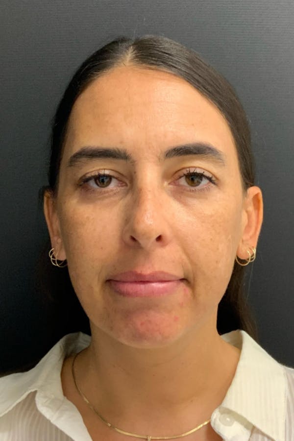 Neck Lift Before & After Gallery - Patient 346653 - Image 3