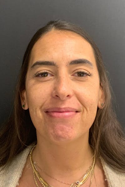 Neck Lift Before & After Gallery - Patient 346653 - Image 4