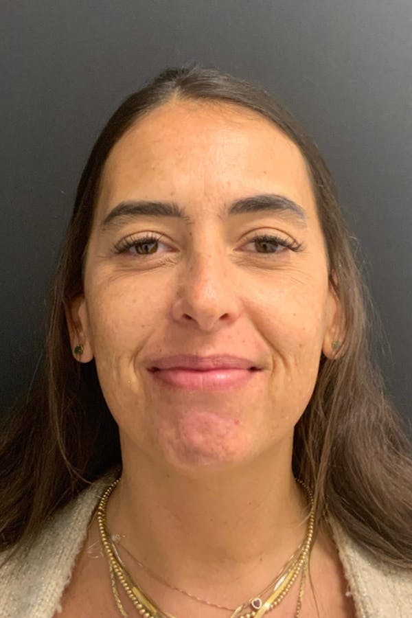 Neck Lift Before & After Gallery - Patient 346653 - Image 4