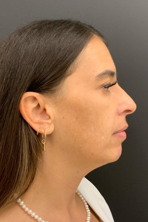 Neck Lift Before & After Gallery - Patient 346653 - Image 5