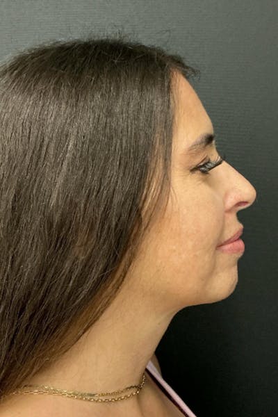 Neck Lift Before & After Gallery - Patient 346653 - Image 6