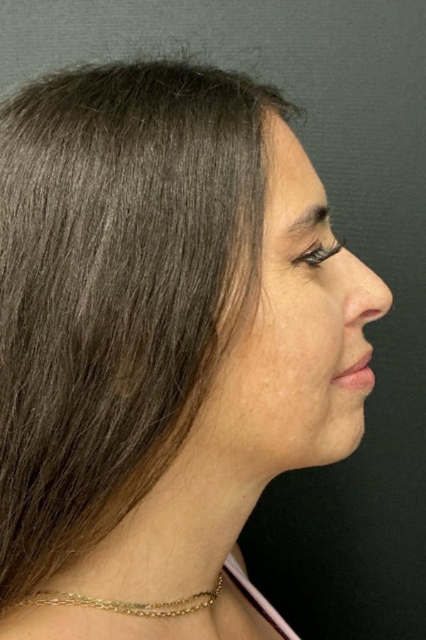 Neck Lift Before & After Gallery - Patient 346653 - Image 6