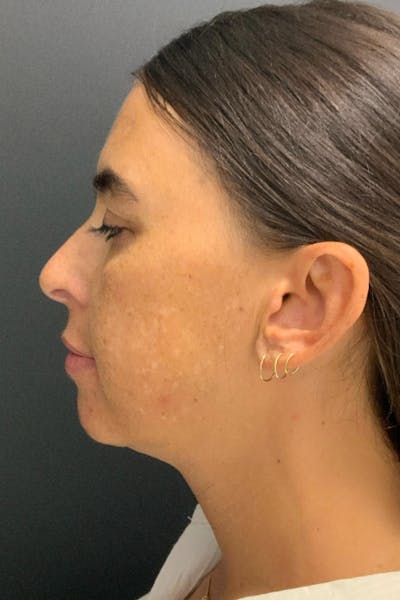 Neck Lift Before & After Gallery - Patient 346653 - Image 1