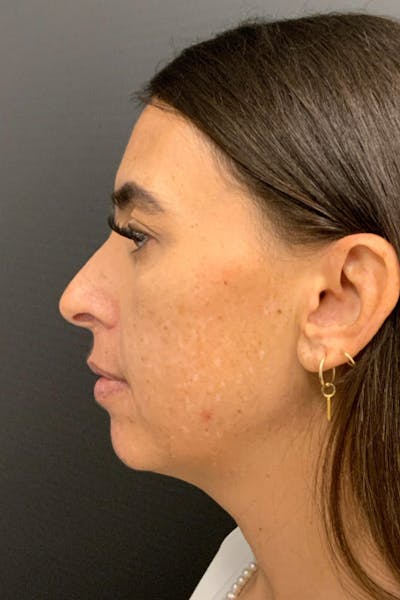 Neck Lift Before & After Gallery - Patient 346653 - Image 2