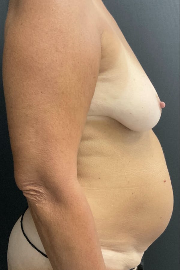 Mommy Makeover Before & After Gallery - Patient 159870 - Image 3