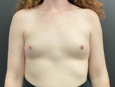 Breast Augmentation Before & After Gallery - Patient 178859 - Image 1