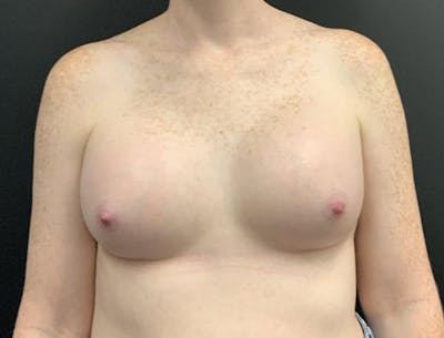 Breast Augmentation Before & After Gallery - Patient 178859 - Image 2