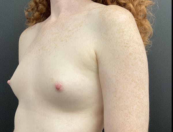Breast Augmentation Before & After Gallery - Patient 178859 - Image 5