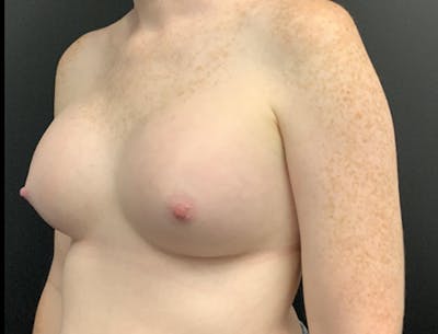 Breast Augmentation Before & After Gallery - Patient 178859 - Image 6