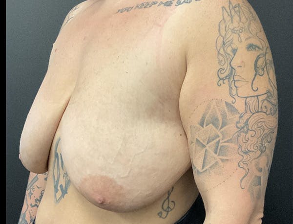 Breast Reduction Before & After Gallery - Patient 237534 - Image 5