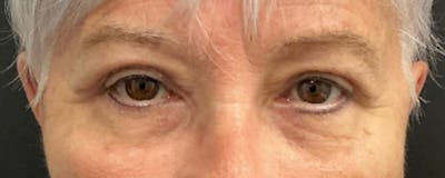 Blepharoplasty Before & After Gallery - Patient 276630 - Image 2