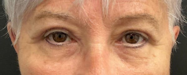 Blepharoplasty Before & After Gallery - Patient 276630 - Image 2
