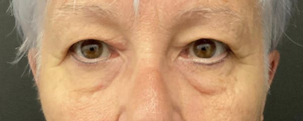 Blepharoplasty Before & After Gallery - Patient 276630 - Image 1