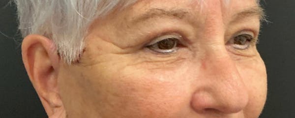 Blepharoplasty Before & After Gallery - Patient 276630 - Image 4