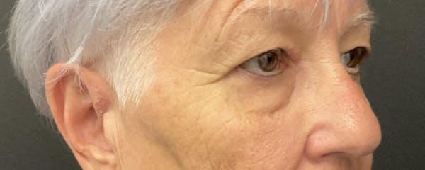 Blepharoplasty Before & After Gallery - Patient 276630 - Image 3