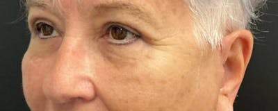 Blepharoplasty Before & After Gallery - Patient 276630 - Image 6