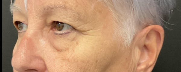 Blepharoplasty Before & After Gallery - Patient 276630 - Image 5