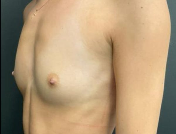 Breast Augmentation Before & After Gallery - Patient 281873 - Image 3