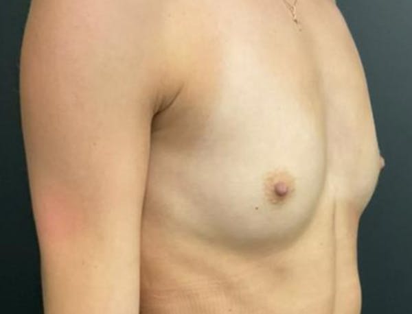 Breast Augmentation Before & After Gallery - Patient 281873 - Image 5
