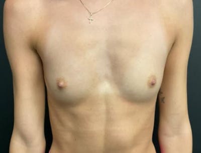 Breast Augmentation Before & After Gallery - Patient 281873 - Image 1