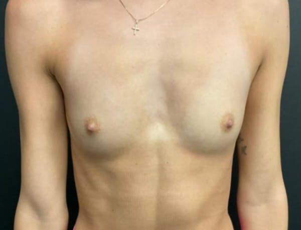 Breast Augmentation Before & After Gallery - Patient 281873 - Image 1
